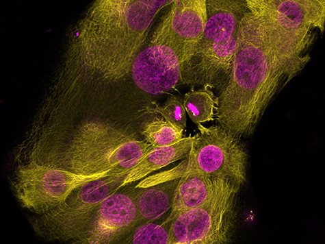yellow and purple cancer cell