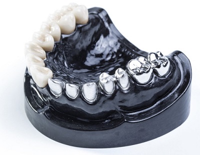 example 3d dental slm
